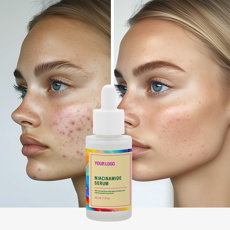 Hot Sale Customized Niacinamide Beauty Face Acne Cleansing Skincare Niacinamide Anti-acne Serum